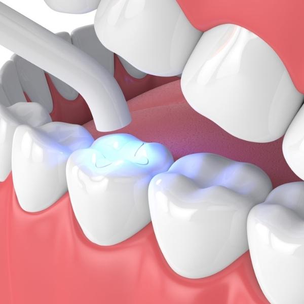 Composite Filling