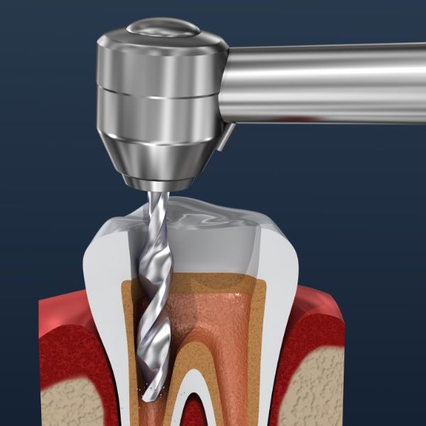 Gum & Bone Procedure