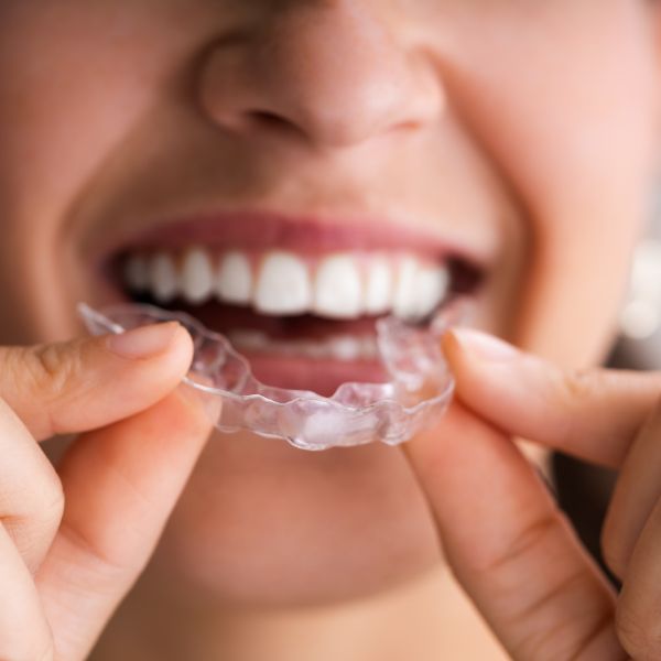 Invisible Aligners