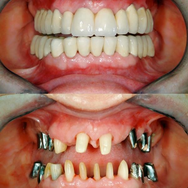 Mouth-Reconstruction