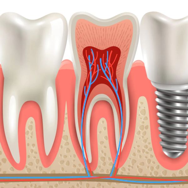 Root Canal Treatment